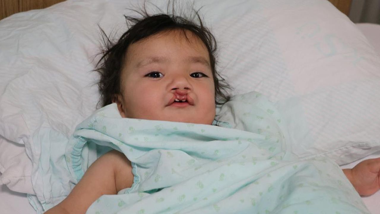 Kahramanmaraş'ta 9 aylık bebeğe Türk lalesi ameliyatı yapıldı