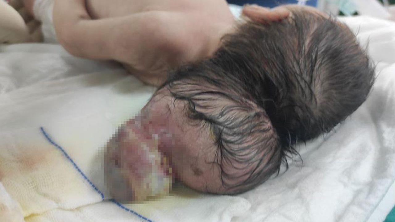 Kahramanmaraş'ta bebek beyninin yarısı kafatası dışında dünyaya geldi