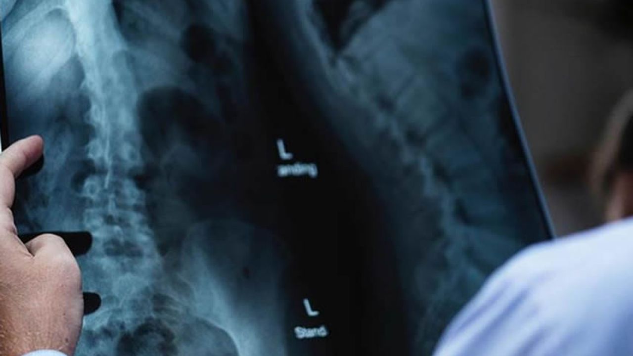 1 yıldır yemek yiyemeyen adamın midesinin röntgeni çekildi, çıktıyı alan doktor hemen ekibini topladı