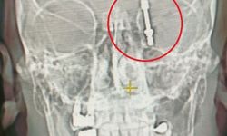 Beynine saplanan implant hayatını kararttı 2 yıldır adalet bekliyor