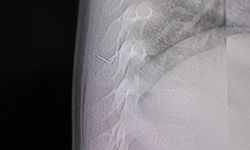 Kahramanmaraş’ta inanılmaz olay! Bebeğin sırtından metal tel çıktı