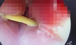 Boğazına saplanan 5 santimlik kemik öldürüyordu