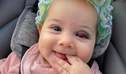 Göz kapağından ameliyat olan 7 aylık bebek bu hale geldi!