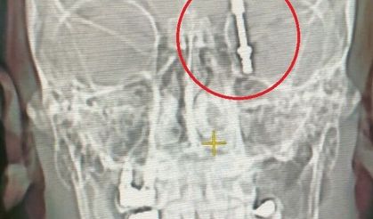 Beynine saplanan implant hayatını kararttı 2 yıldır adalet bekliyor