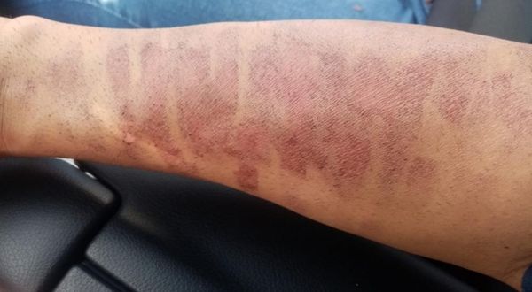 Kahramanmaraş'ta güzellik merkezi skandalı: Lazere gitti kolları yandı!