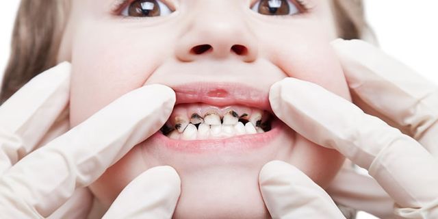 Ebeveynler dikkat! Biberon çürükleri çocukların diş yapısını bozuyor