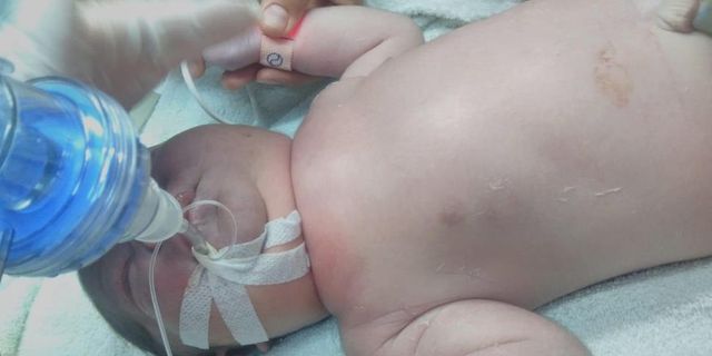 Tüyler ürperten olay! Yeni doğan bebeğin köprücük kemiği kırıldı, vücudu mosmor oldu