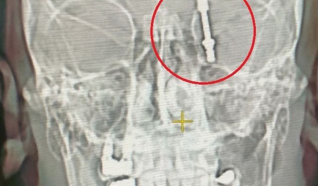 Beynine saplanan implant hayatını kararttı 2 yıldır adalet bekliyor