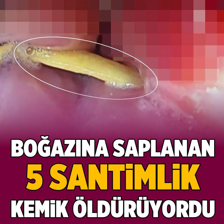 Boğazına saplanan 5 santimlik kemik öldürüyordu