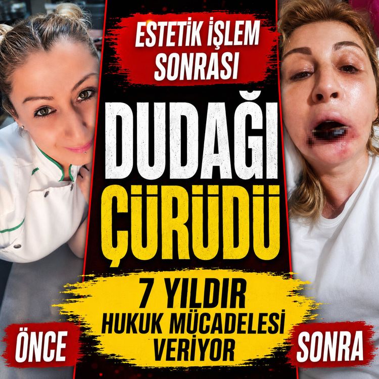 Göz altı için gitti, işlem sonrası dudağı çürüdü!