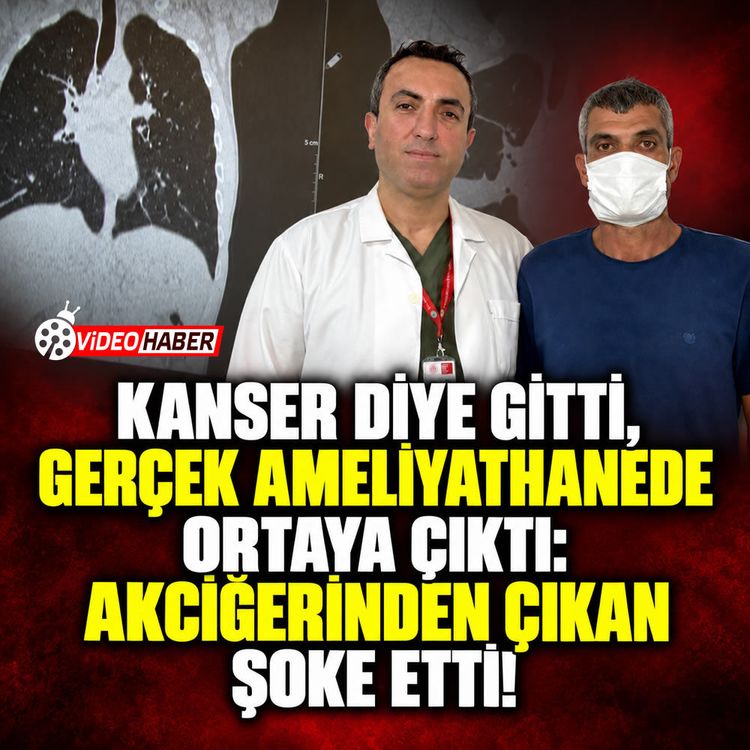 Kanser diye gitti, ameliyathanede gerçek oraya çıktı: Akciğerinden çıkan şoke etti!