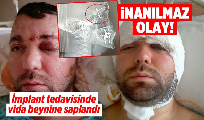 Bursa'da inanılmaz olay: İmplant tedavisinde vida beynine saplandı