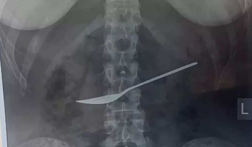 Kızın midesinden çıkana, doktorlar bile şok oldu